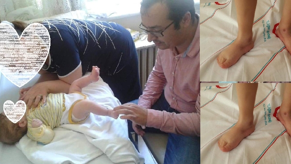 Pes Eqinovarus Cerrahi Tedavisi Yapılan Çocuk Yürüyor 3 20201217 150305